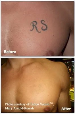 Laser Tattoo Removal before and after pictures!