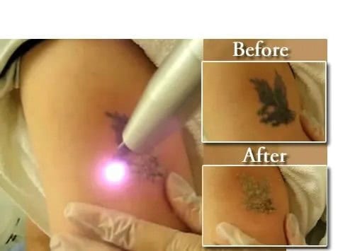 Laser Tattoo Removal before and after pictures!