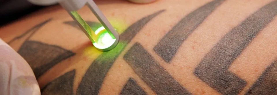 All You Have to Know About Laser Tattoo Removal