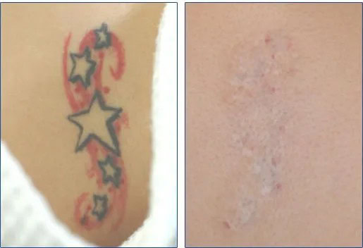 Laser Tattoo Removal before and after pictures!