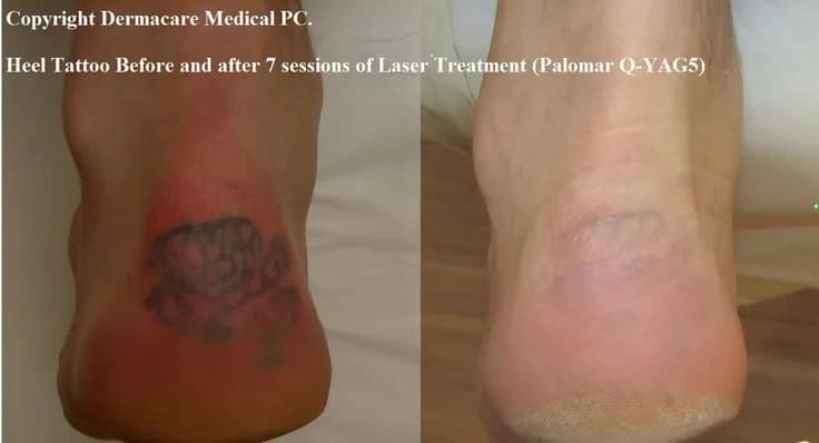 Laser Tattoo Removal before and after pictures!