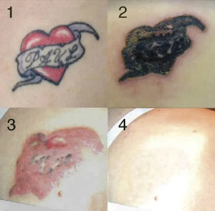 Laser Tattoo Removal before and after pictures!